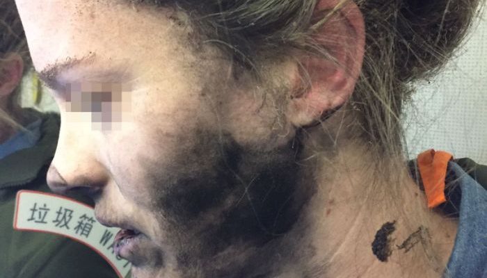Headphones explode on woman’s face during flight | Secret Flying Headphones explode on woman’s face during flight | Secret Flying