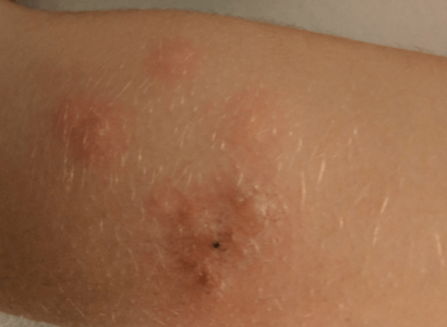 British Airways apologises for bed bug infestation | Secret Flying