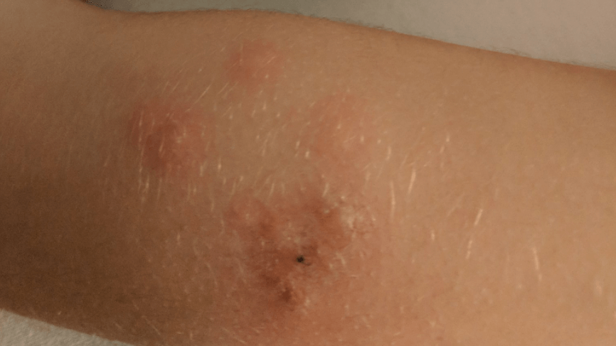 British Airways apologises for bed bug infestation