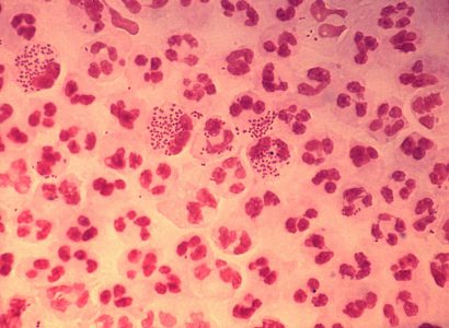 British man has untreatable ‘super-gonorrhea’ after a sexual encounter with a woman in South-East Asia | Secret Flying