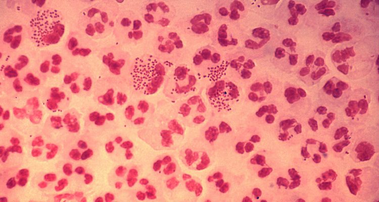 British man has untreatable ‘super-gonorrhea’ after a sexual encounter with a woman in South-East Asia | Secret Flying British man has untreatable ‘super-gonorrhea’ after a sexual encounter with a woman in South-East Asia | Secret Flying