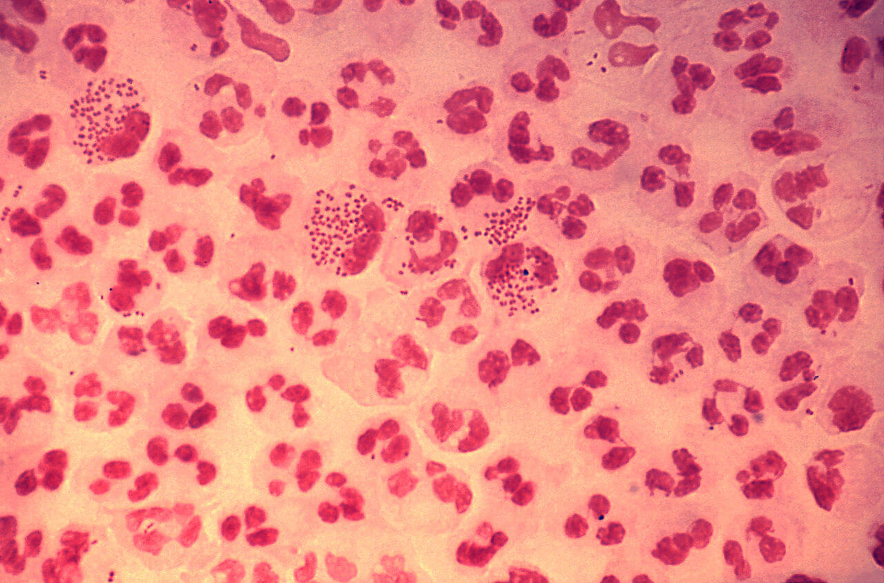 British man has untreatable ‘super-gonorrhea’ after a sexual encounter with a woman in South-East Asia