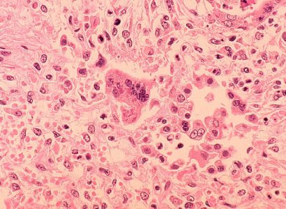 Officials warn of measles exposure at Philadelphia airport | Secret Flying