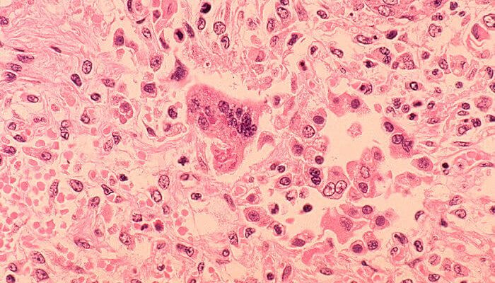 Officials warn of measles exposure at Philadelphia airport | Secret Flying Officials warn of measles exposure at Philadelphia airport | Secret Flying
