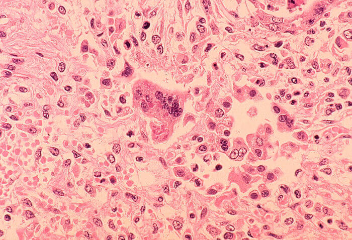 Officials warn of measles exposure at Philadelphia airport